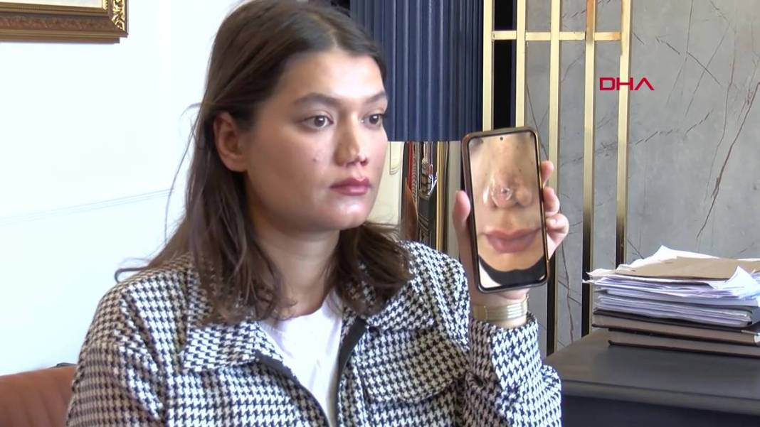 Estetik operasyon sonrası burnu düştü! Aynı doktora iki ameliyat oldu, sonuç değişmedi, mahkemeye verdi 6